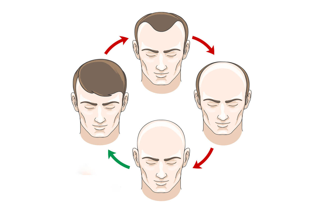 When Do Guys Start To Go Bald: Complete Guide & Key Details